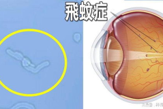 什么是飞蚊症怎么治疗,飞蚊症成因解析与多元化治疗策略